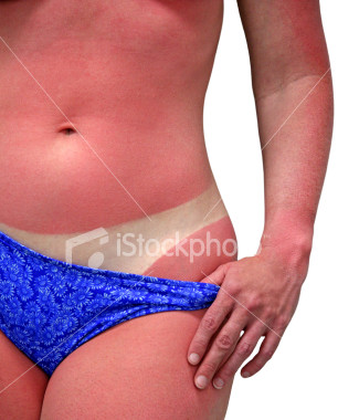 ist2_1693288_woman_with_sunburn_isolated.jpg